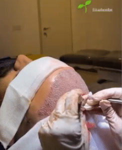 نمونه کاشت مو دکتر گالیا رنجبری