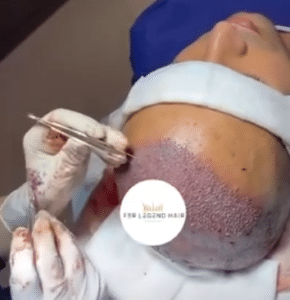 نمونه کاشت مو دکتر گالیا رنجبری