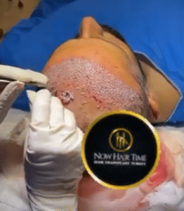 نمونه کاشت مو دکتر گالیا رنجبری