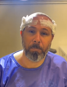 نمونه کاشت مو دکتر گالیا رنجبری