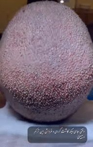 نمونه کاشت مو کلینیک زیبایی ژینو