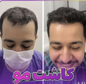 نمونه کاشت مو کلینیک زیبایی ژینو