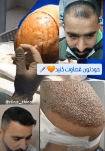 نمونه کاشت مو کلینیک زیبایی ژینو