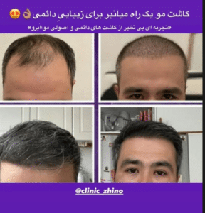 نمونه کاشت مو کلینیک زیبایی ژینو