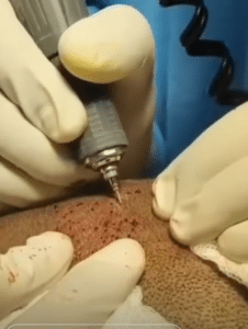 نمونه کاشت مو کلینیک زیبایی ژینو