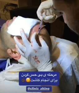 نمونه کاشت مو کلینیک زیبایی ژینو