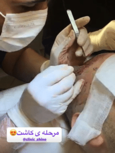 نمونه کاشت مو کلینیک زیبایی ژینو