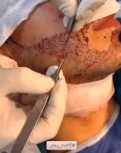 نمونه کاشت مو کلینیک زیبایی ژینو