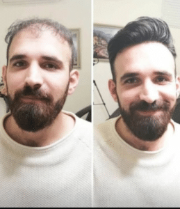 نمونه کاشت مو کلینیک زیبایی ژینو