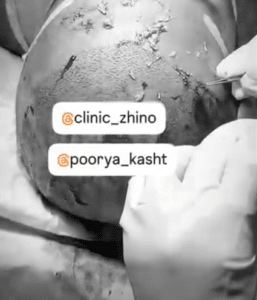 نمونه کاشت مو کلینیک زیبایی ژینو