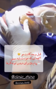 نمونه کاشت مو کلینیک زیبایی ژینو