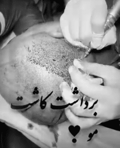 نمونه کاشت مو کلینیک زیبایی ژینو