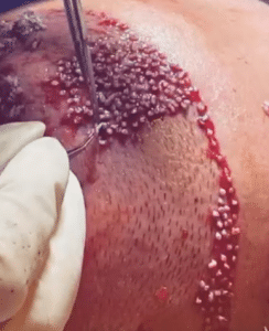 نمونه کاشت مو کلینیک زیبایی ژینو