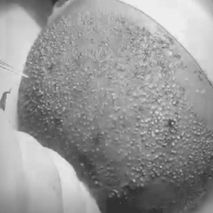 نمونه کاشت مو کلینیک زیبایی ژینو