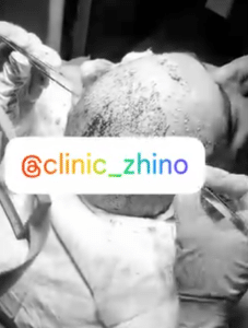 نمونه کاشت مو کلینیک زیبایی ژینو