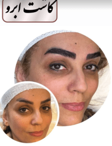 نمونه کاشت ابرو کلینیک زیبایی ژینو