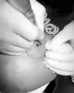 نمونه کاشت مو کلینیک زیبایی ژینو