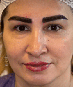 نمونه کاشت ابرو کلینیک زیبایی ژینو