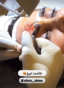 نمونه کاشت ابرو کلینیک زیبایی ژینو