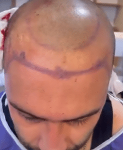 نمونه کاشت ابرو کلینیک زیبایی ژینوز