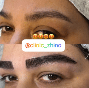 نمونه کاشت ابرو کلینیک زیبایی ژینو