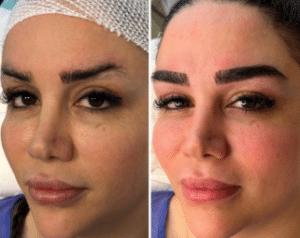 نمونه کاشت ابرو کلینیک زیبایی ژینو