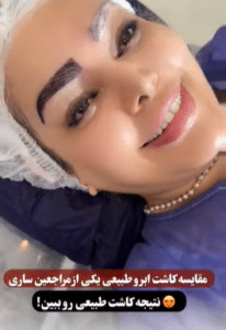 نمونه کاشت ابرو کلینیک زیبایی دانژه