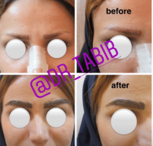 نمونه کاشت ابرو کلینیک طبیب