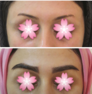 نمونه کاشت ابرو کلینیک طبیب