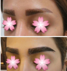 نمونه کاشت ابرو کلینیک طبیب