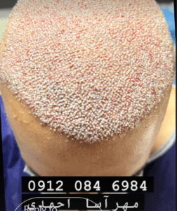 نمونه کاشت مو کلینیک زیبایی و لاغری آسا