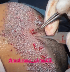 نمونه کاشت مو کلینیک زیبایی و لاغری آسا