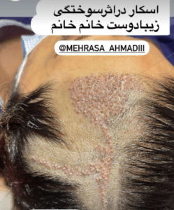 نمونه کاشت مو کلینیک زیبایی و لاغری آسا