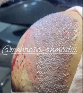 نمونه کاشت مو کلینیک زیبایی و لاغری آسا