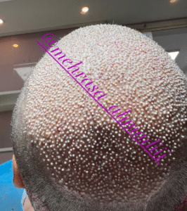 نمونه کاشت مو کلینیک زیبایی و لاغری آسا