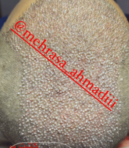 نمونه کاشت مو کلینیک زیبایی و لاغری آسا