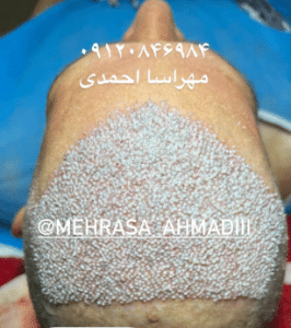 نمونه کاشت مو کلینیک زیبایی و لاغری آسا