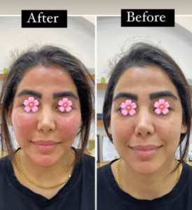 نمونه تزریق چربی دکتر مینا ملا احمدی