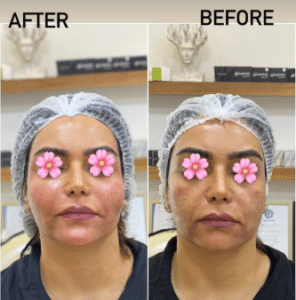 نمونه تزریق چربی دکتر مینا ملا احمدی