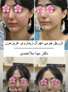 نمونه تزریق چربی دکتر مینا ملا احمدی