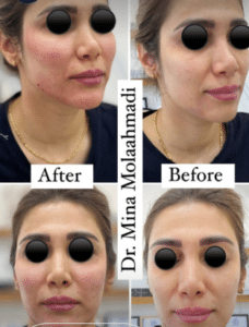 نمونه تزریق چربی دکتر مینا ملا احمدی