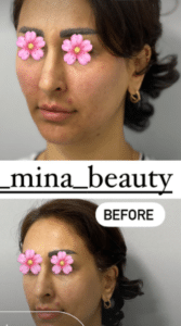 نمونه تزریق چربی دکتر مینا ملا احمدی