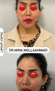 نمونه تزریق چربی دکتر مینا ملا احمدی