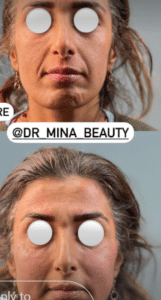 نمونه تزریق چربی دکتر مینا ملا احمدی