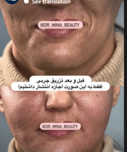نمونه تزریق چربی دکتر مینا ملا احمدی