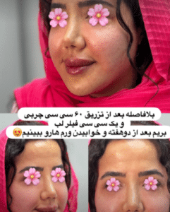 نمونه تزریق چربی دکتر مینا ملا احمدی