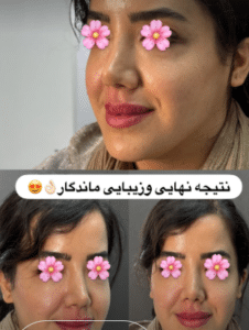 نمونه تزریق چربی دکتر مینا ملا احمدی