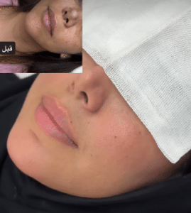 نمونه تزریق چربی دکتر مینا ملا احمدی