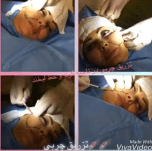 نمونه تزریق چربی دکتر امید یوسف نژاد