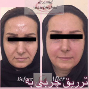 نمونه تزریق چربی دکتر امید یوسف نژاد